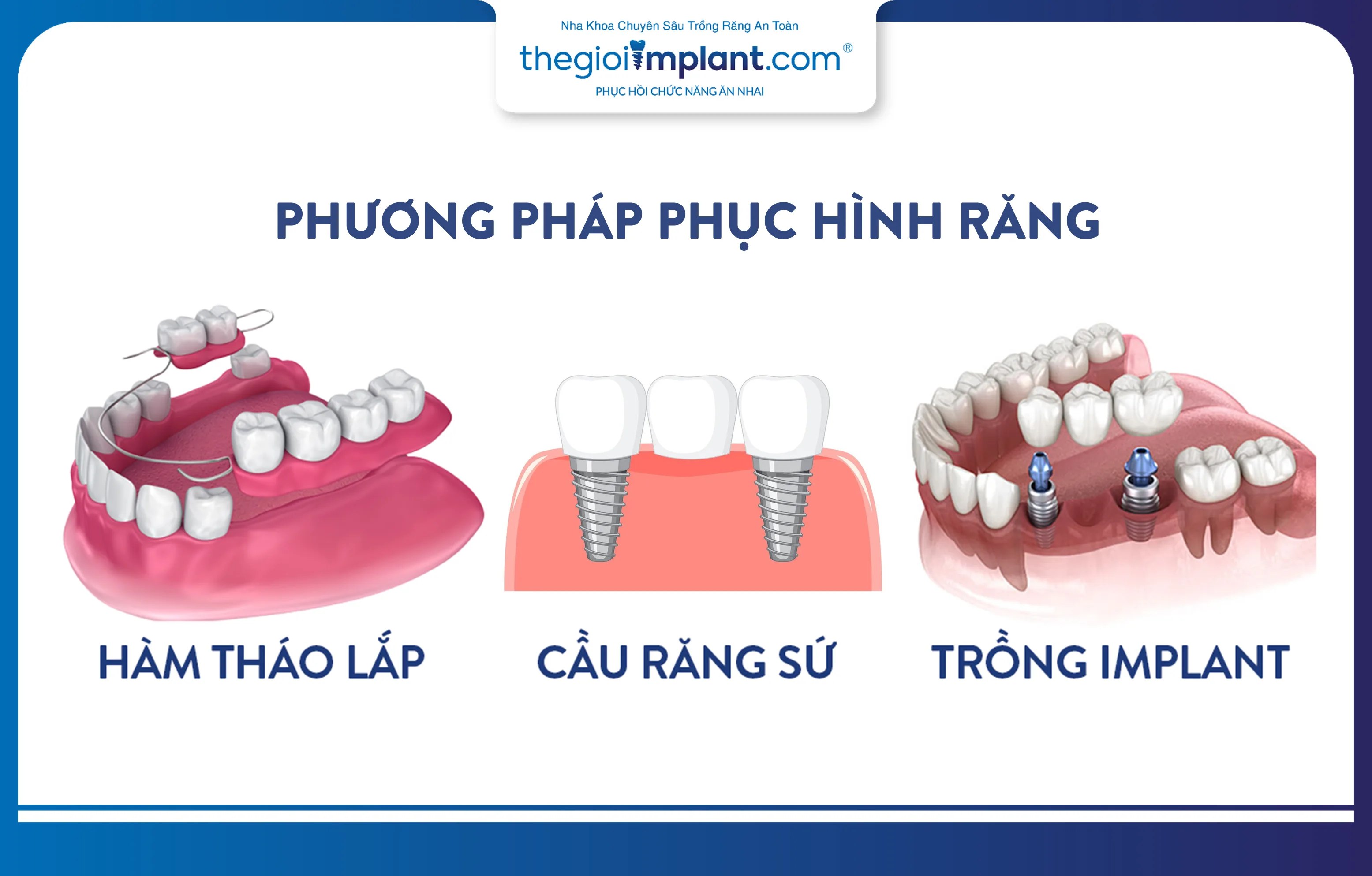 Các phương pháp phục hình răng mất phổ biến