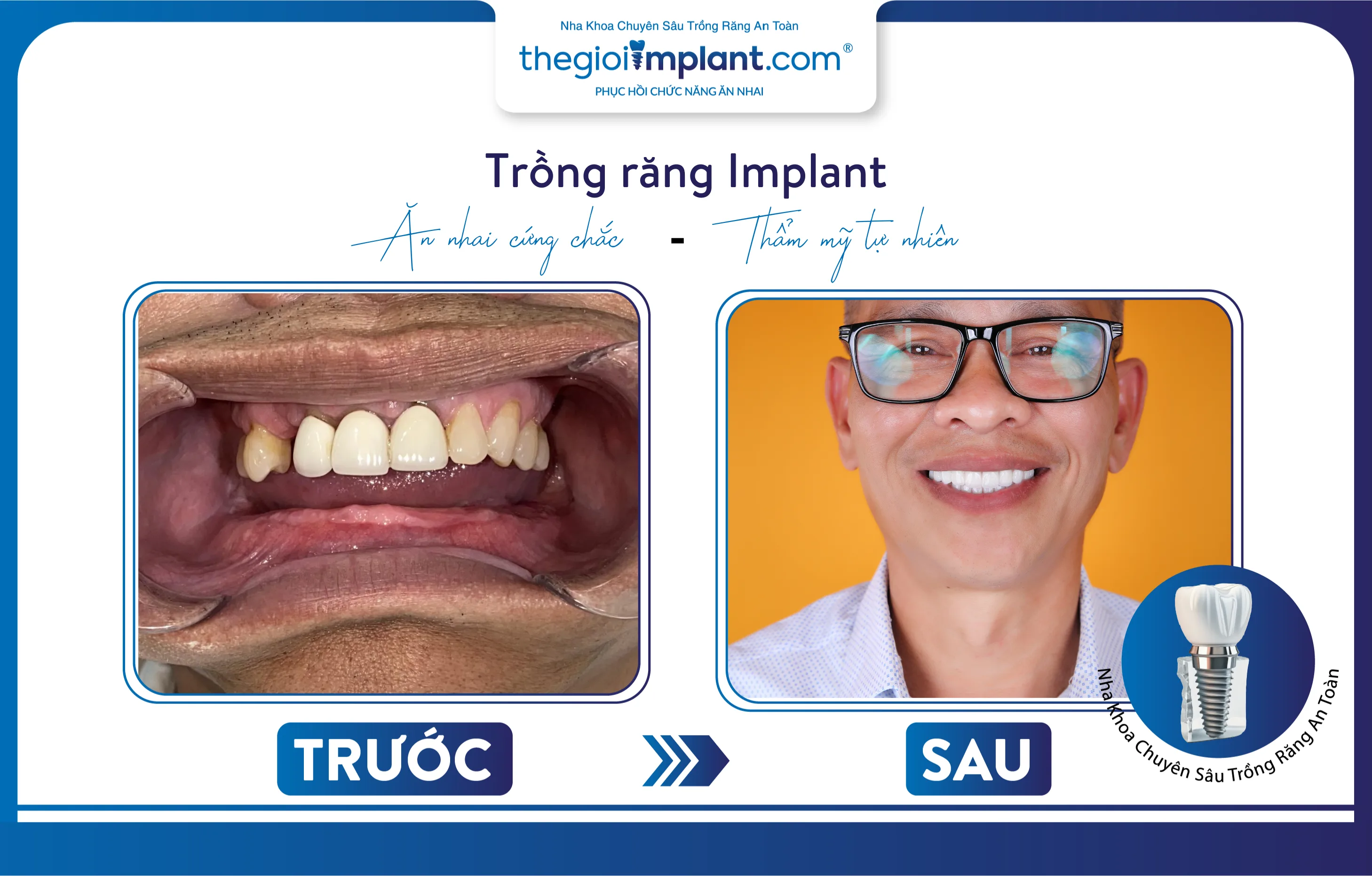 kết quả trước - sau trồng răng Implant của chú Chí Mỹ Hòa