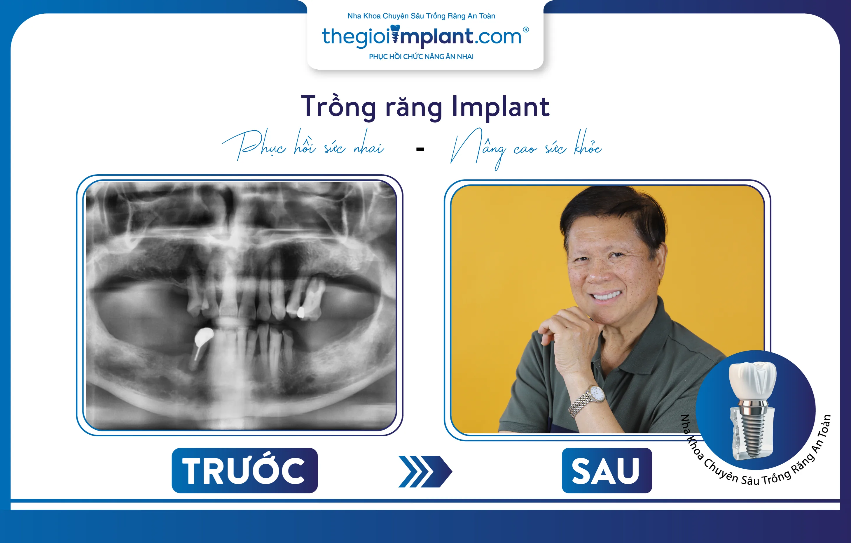 Kết quả trước - sau trồng răng Implant cho chú Thiện Dũng