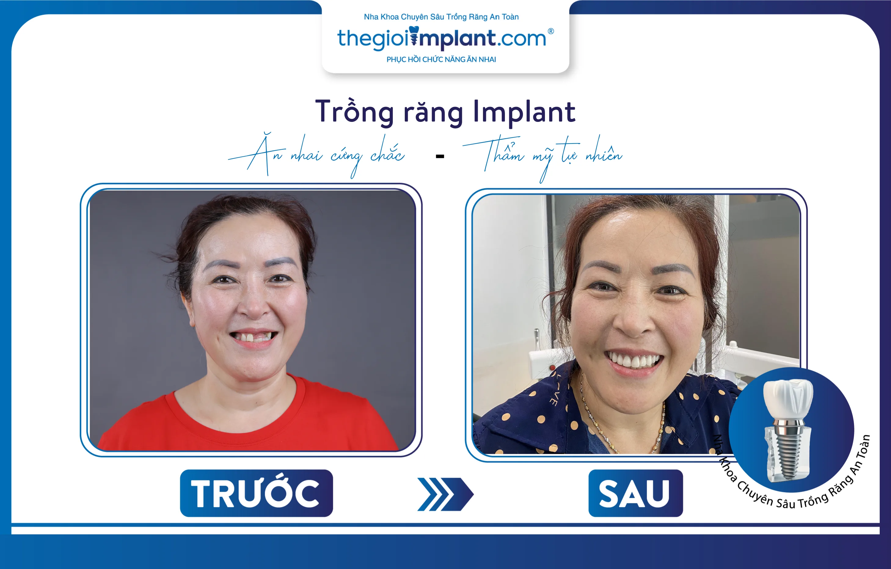 kết quả trước - sau trồng răng Implant của cô Diễm