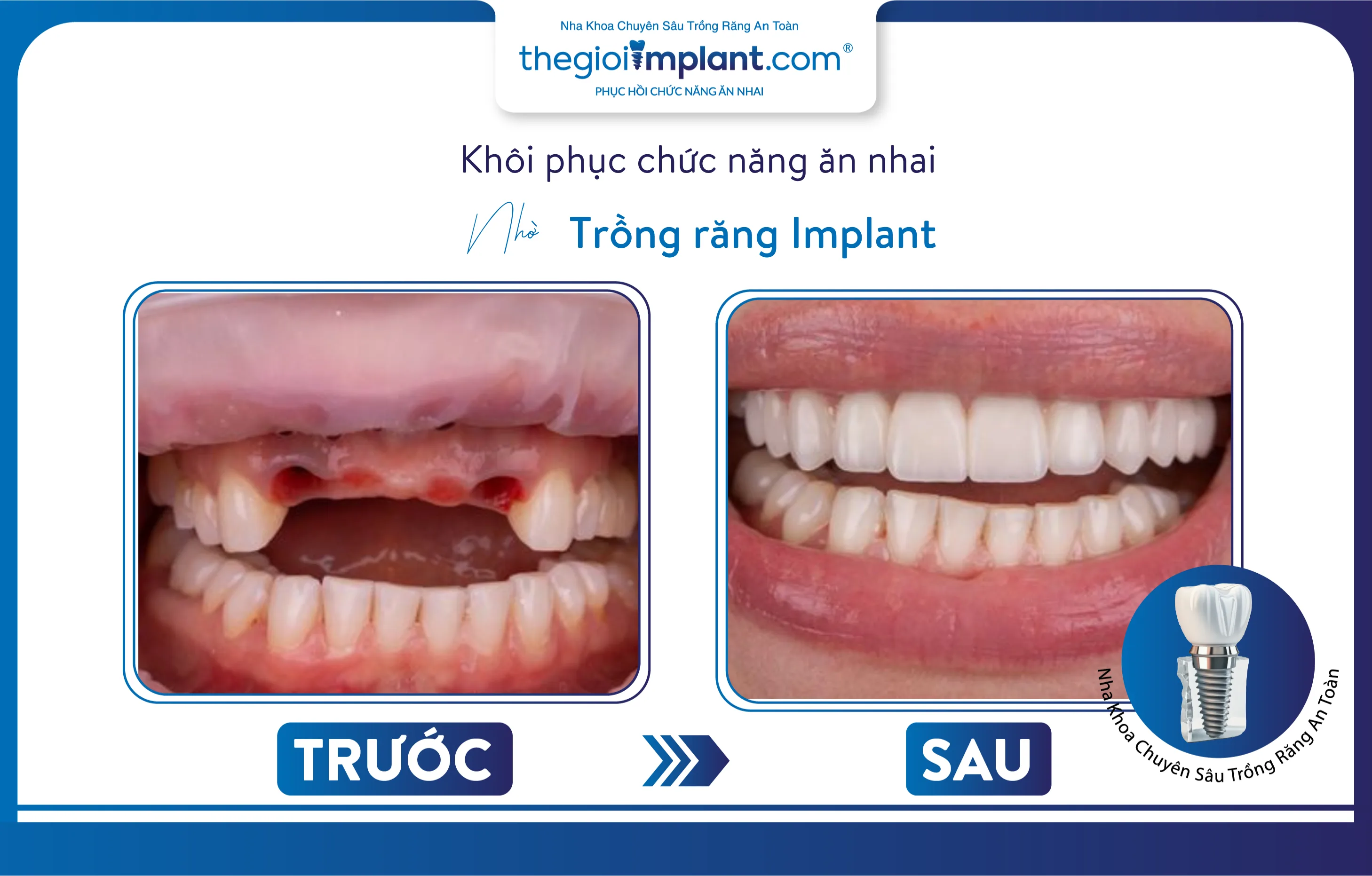 mất răng do cầu răng sứ