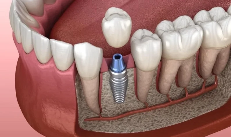 Thế Giới Implant