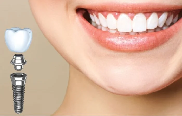 Thế Giới Implant