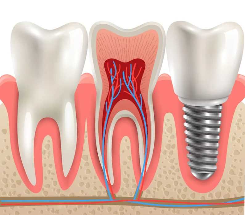 Thế Giới Implant