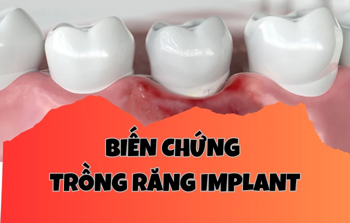 Biến chứng trồng răng Implant và những điều cần lưu ý