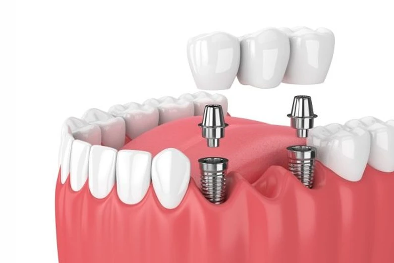Thế Giới Implant