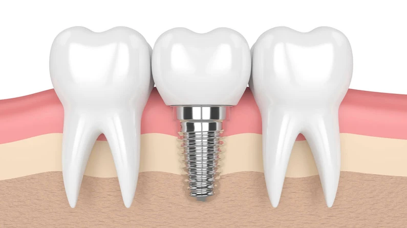Thế Giới Implant
