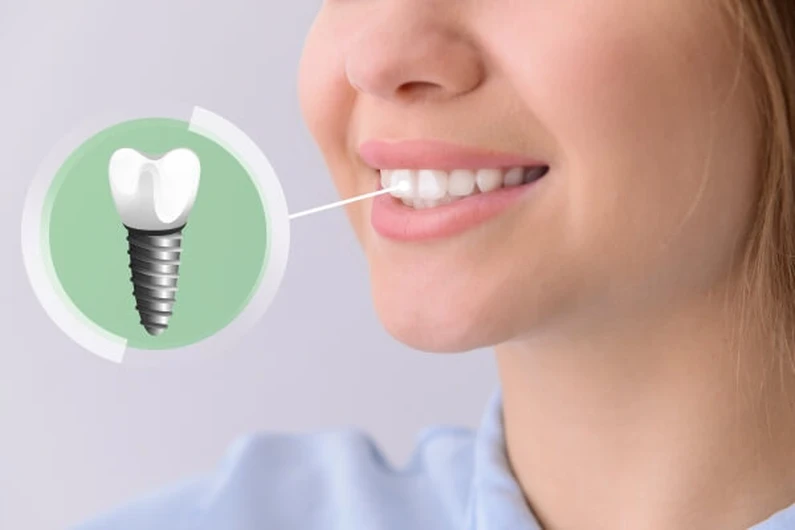 Thế Giới Implant