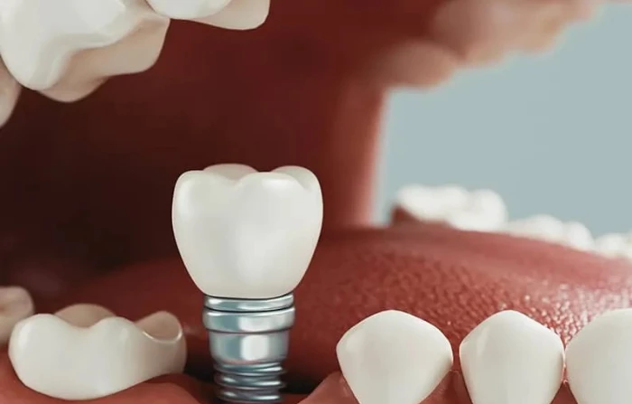 Thế Giới Implant