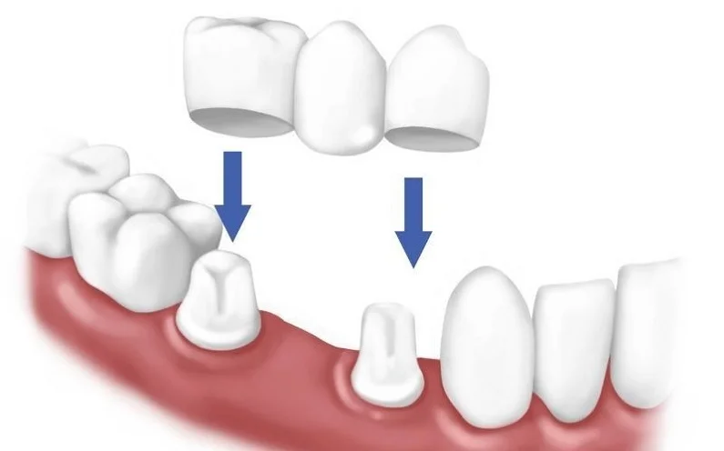 Thế Giới Implant