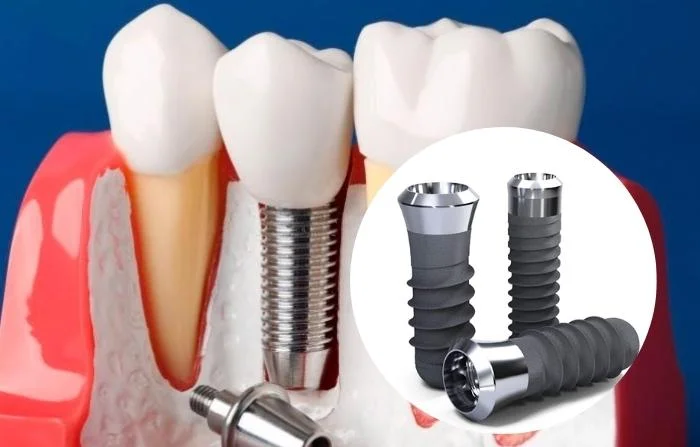 Nên trồng răng implant loại nào thì tốt?