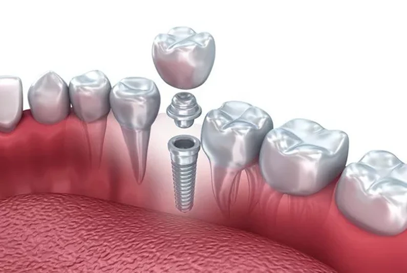 Thế Giới Implant