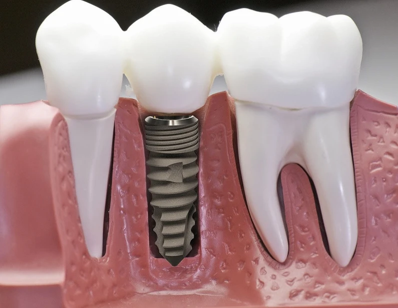 Thế Giới Implant