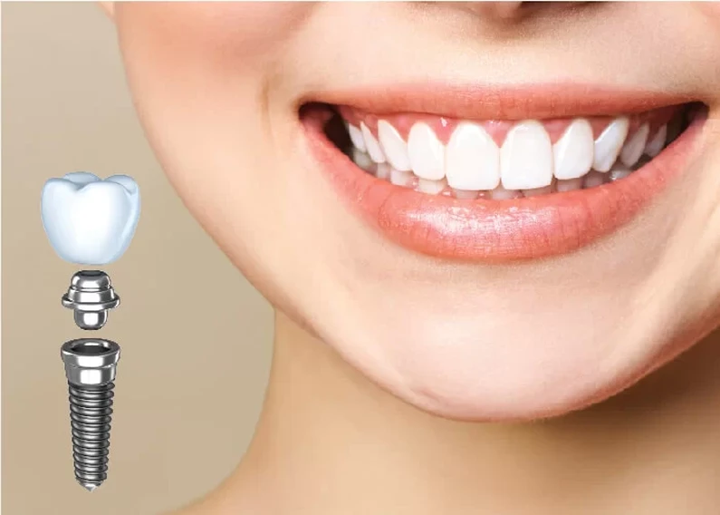 Thế Giới Implant