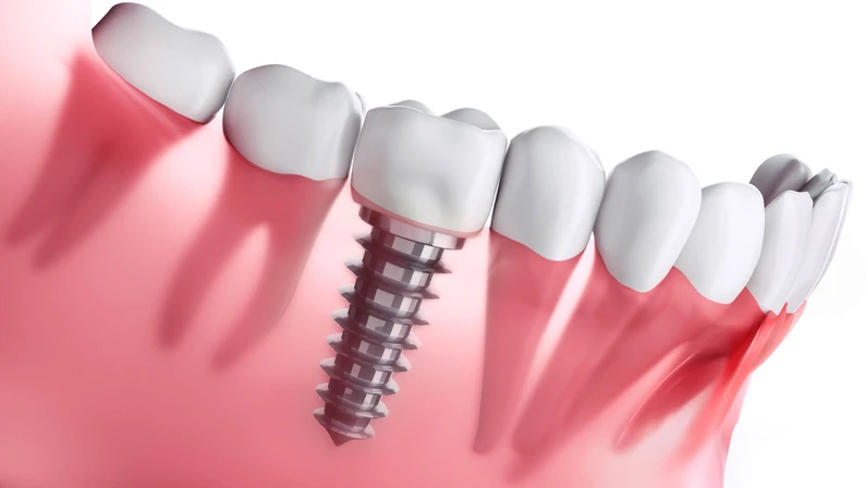 Thế Giới Implant