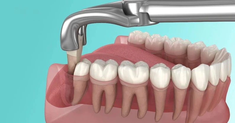 Thế Giới Implant