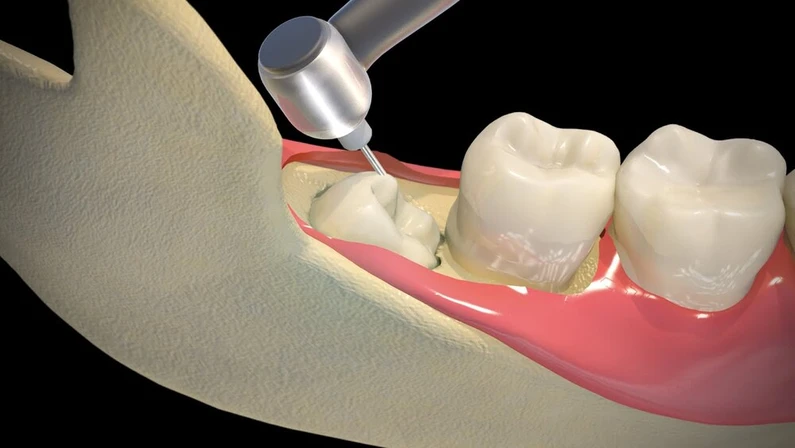 Thế Giới Implant