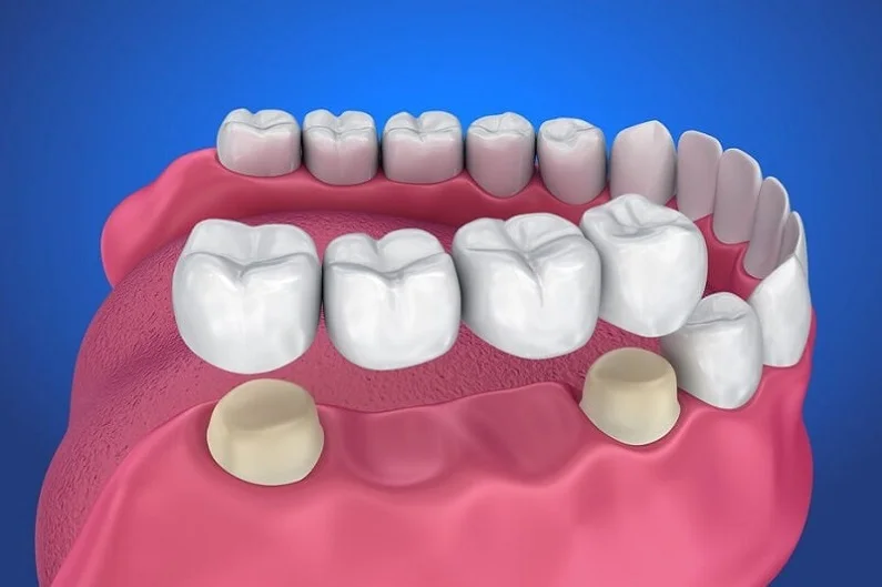 Thế Giới Implant