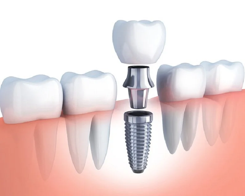 Thế Giới Implant