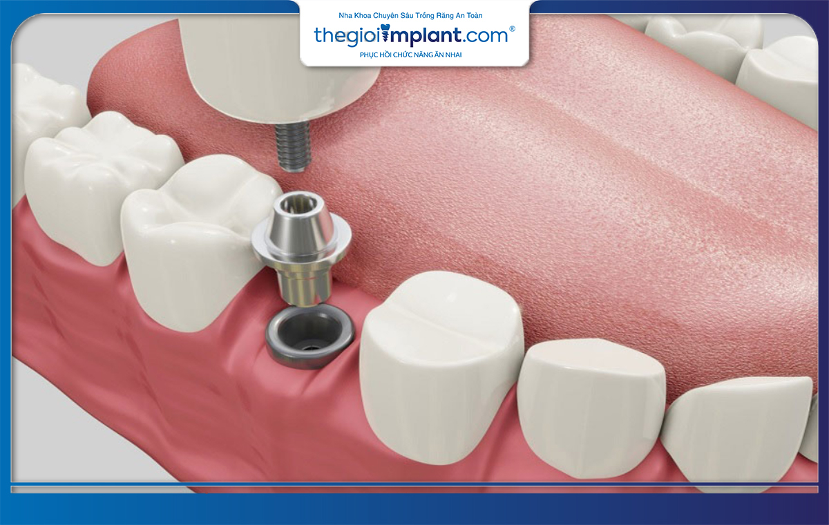 Trụ implant chất lượng giúp mang đến kết quả phục hình như ý