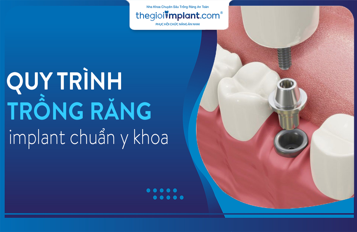 quy trình trồng răng implant