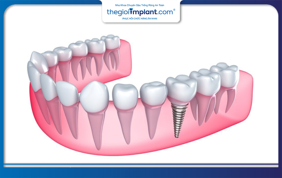 Trồng răng implant sau 1-2 tháng nhổ răng thường là lựa chọn an toàn và hiệu quả