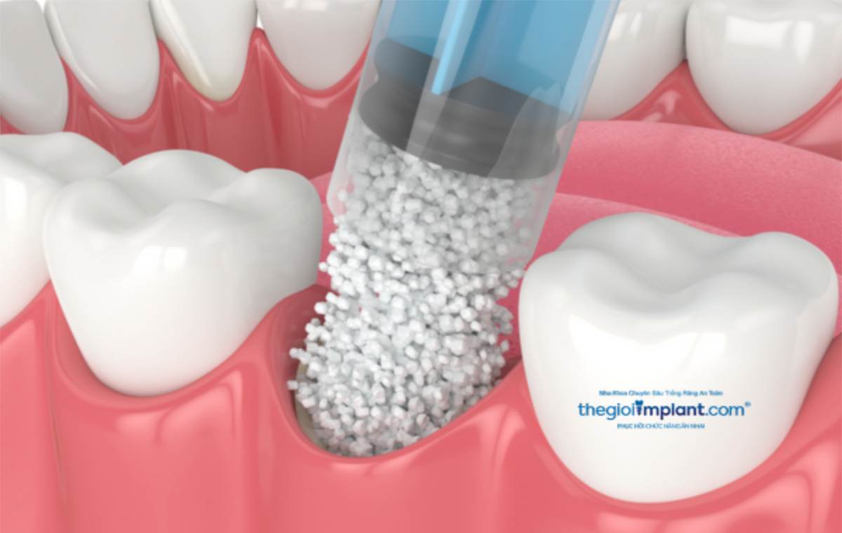 Trong trường hợp phải ghép xương, bạn sẽ được chỉ định trồng răng implant sau 4-12 tháng nhổ răng