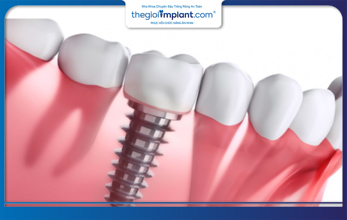 Có cần ghép xương trước khi trồng implant không?