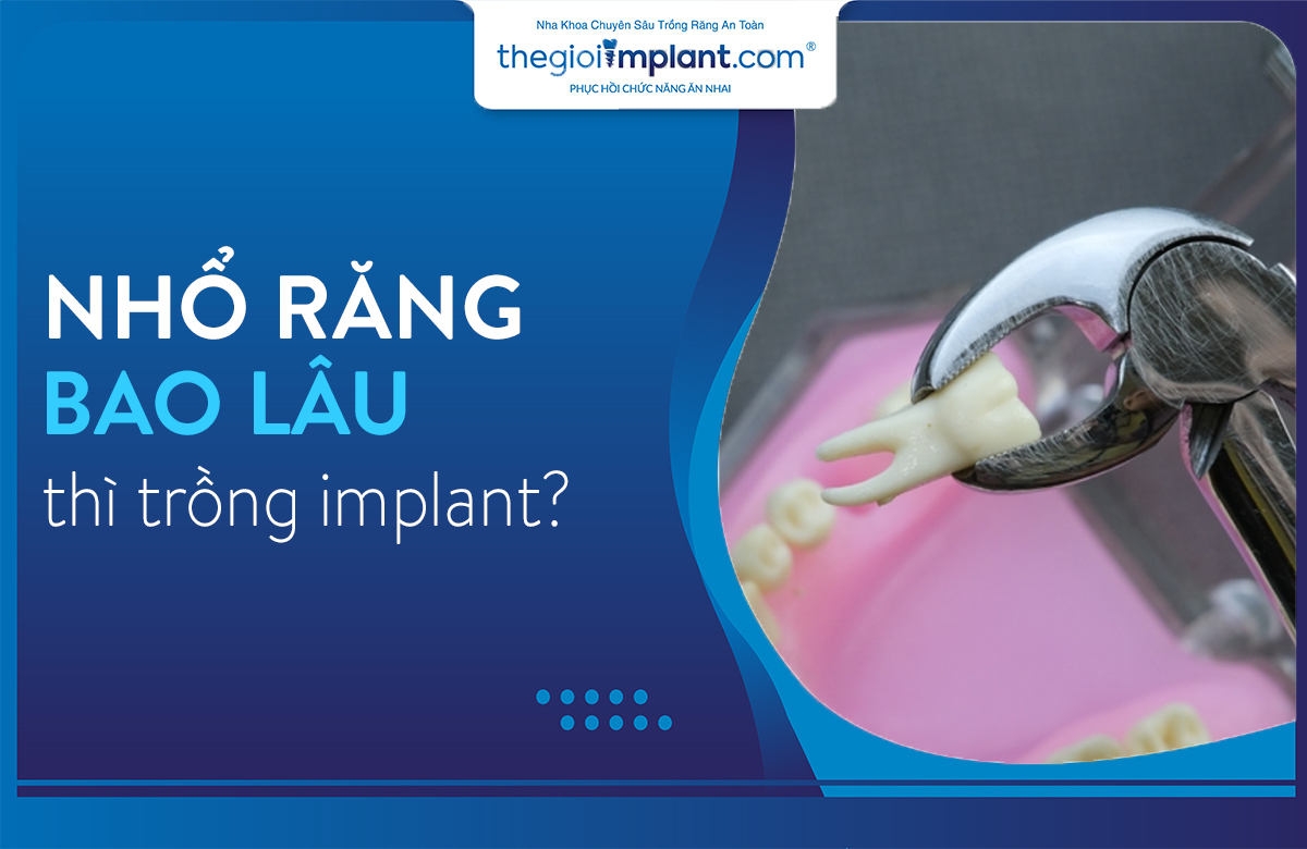 sau khi nhổ răng bao lâu thì trồng implant thumbnail