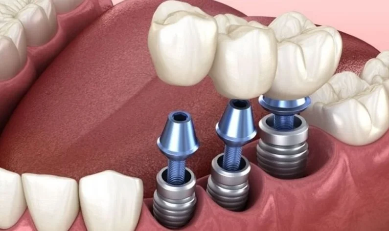 Thế Giới Implant