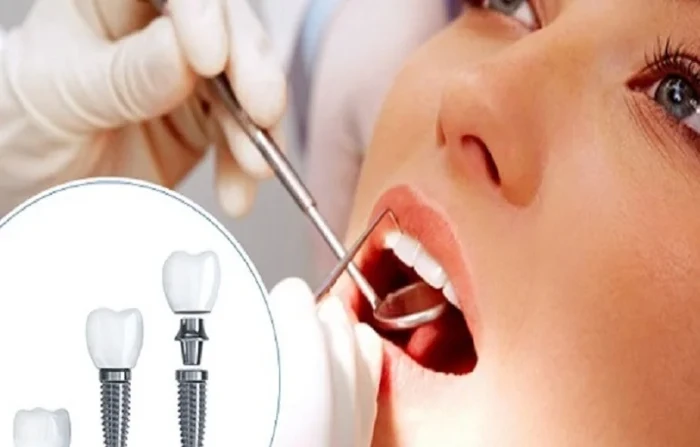 Thế Giới Implant