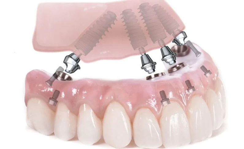 Thế Giới Implant