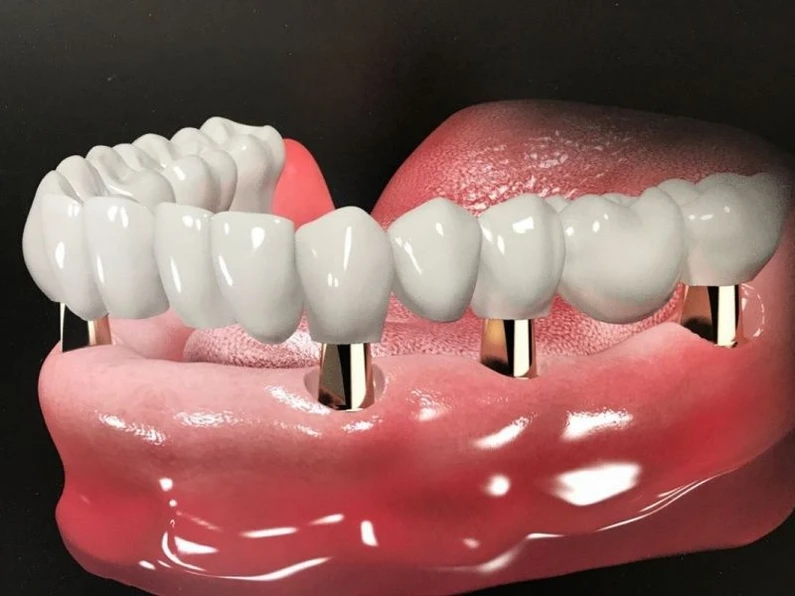 Thế Giới Implant