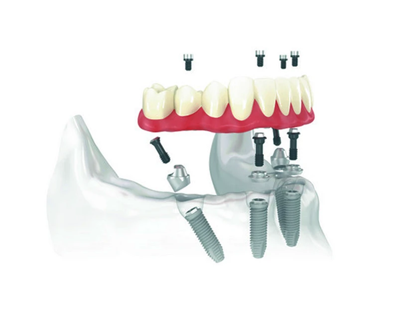 Thế Giới Implant
