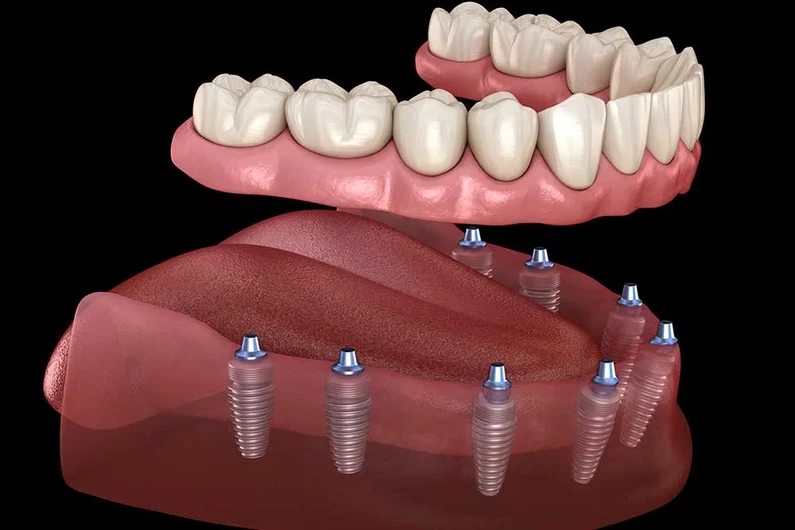 Thế Giới Implant