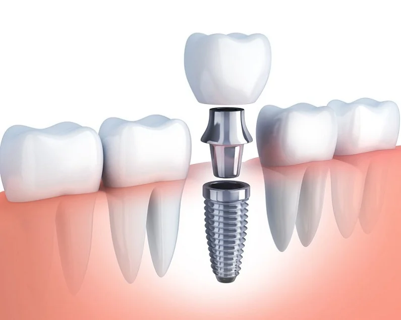 Thế Giới Implant