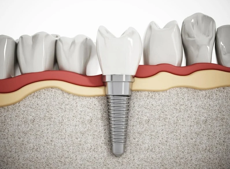 Thế Giới Implant