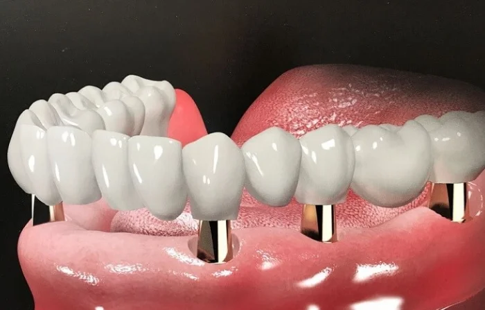 Tất tần tật mọi thứ cần biết về trồng răng Implant