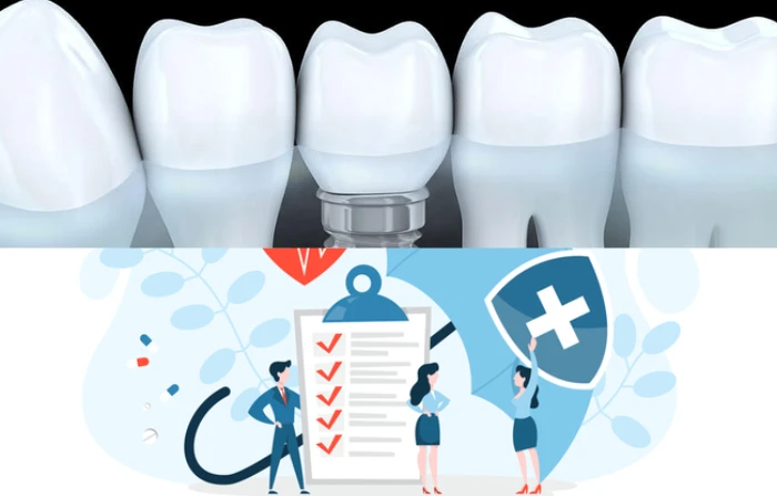 Trồng răng Implant có được bảo hiểm hỗ trợ không?