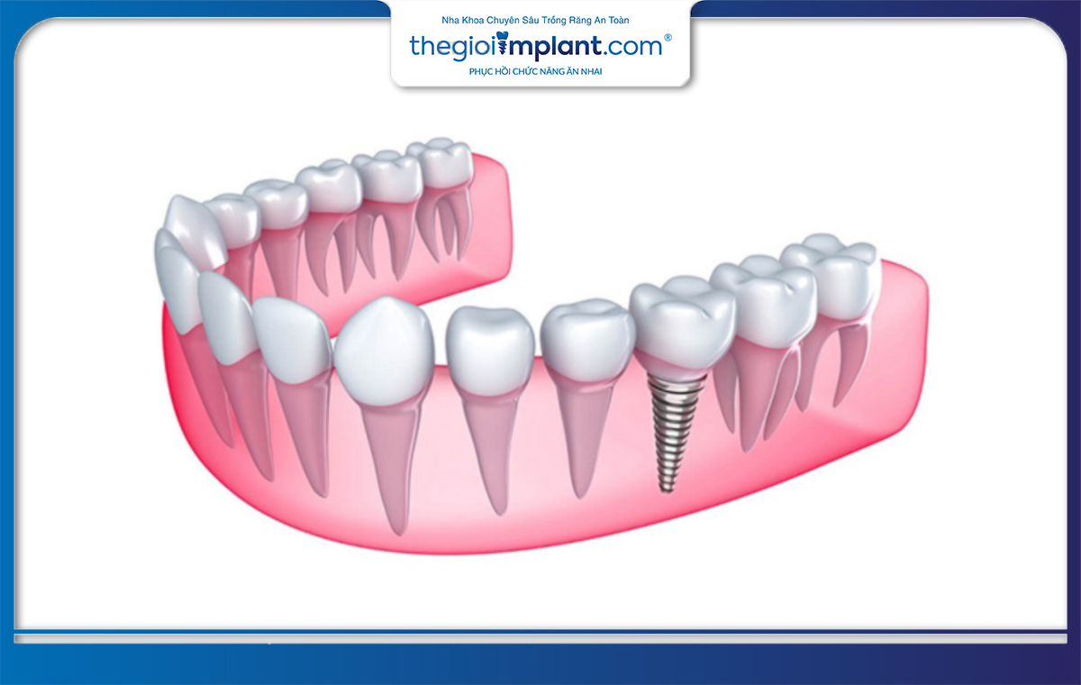 Trồng răng implant có sử dụng bảo hiểm được không?