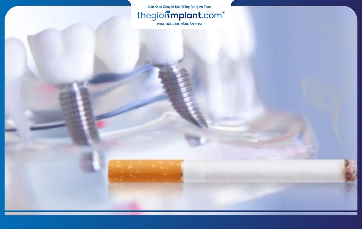 Hút thuốc lá có thể ảnh hưởng đến quá trình tích hợp trụ implant vào xương hàm