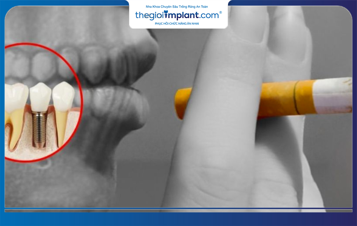 Thuốc lá có ảnh hưởng xấu trong quá trình trồng răng implant