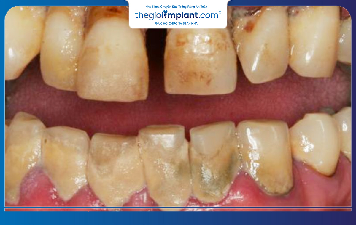 Thuốc lá có ảnh hưởng xấu sau khi trồng răng implant