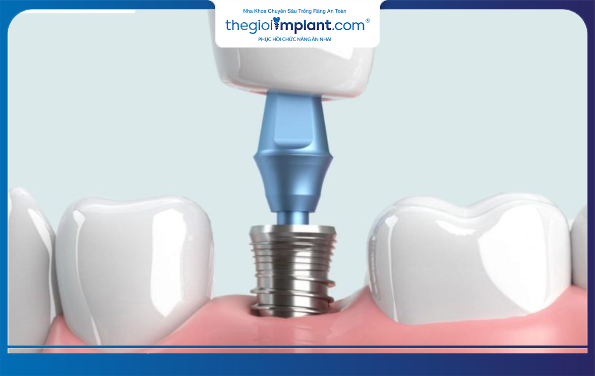 Lưu ý ngay những mẹo hay để gia tăng tuổi thọ của răng implant