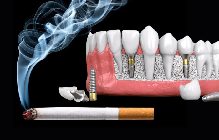 Trồng răng implant có hút thuốc được không? Tác hại thuốc lá