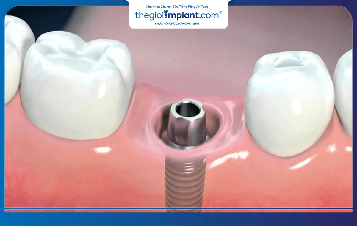 Đặt trụ implant