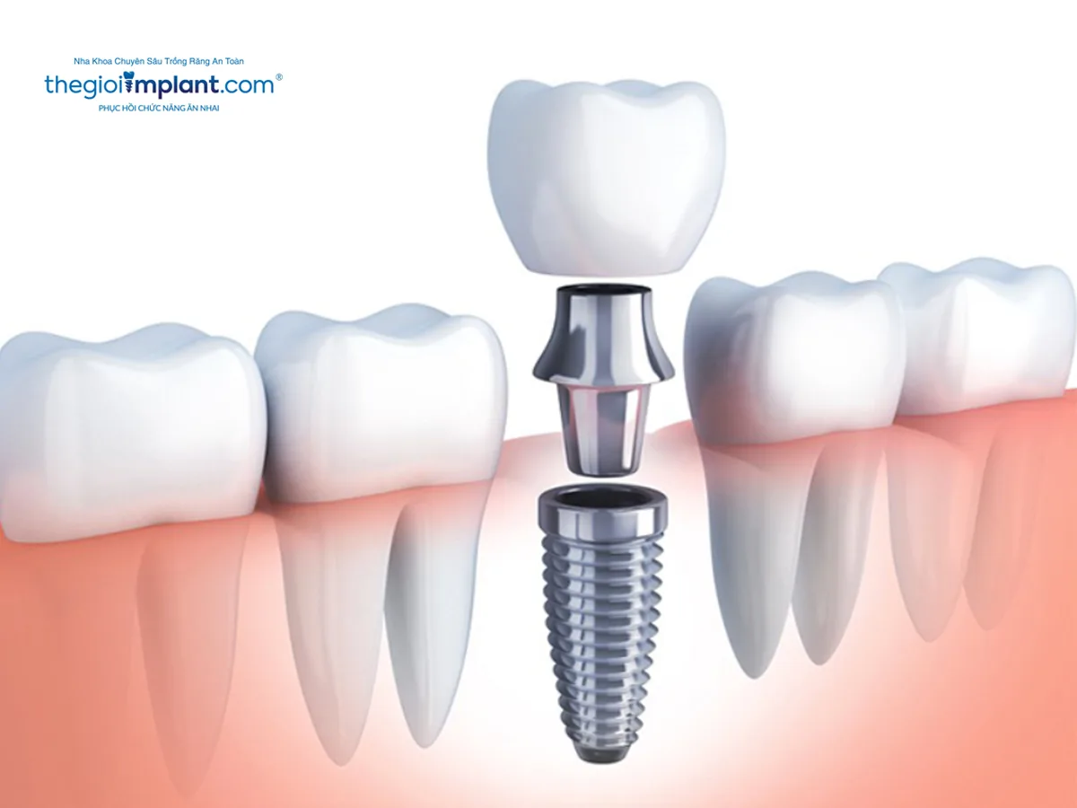 Gắn răng sứ cố định trên implant