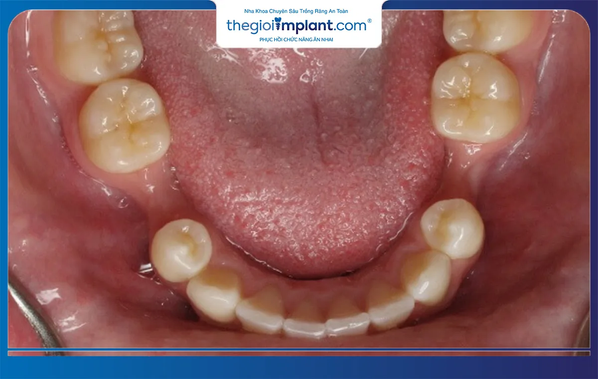 Sức khỏe răng miệng của bệnh nhân ảnh hưởng tới thời gian trồng răng implant
