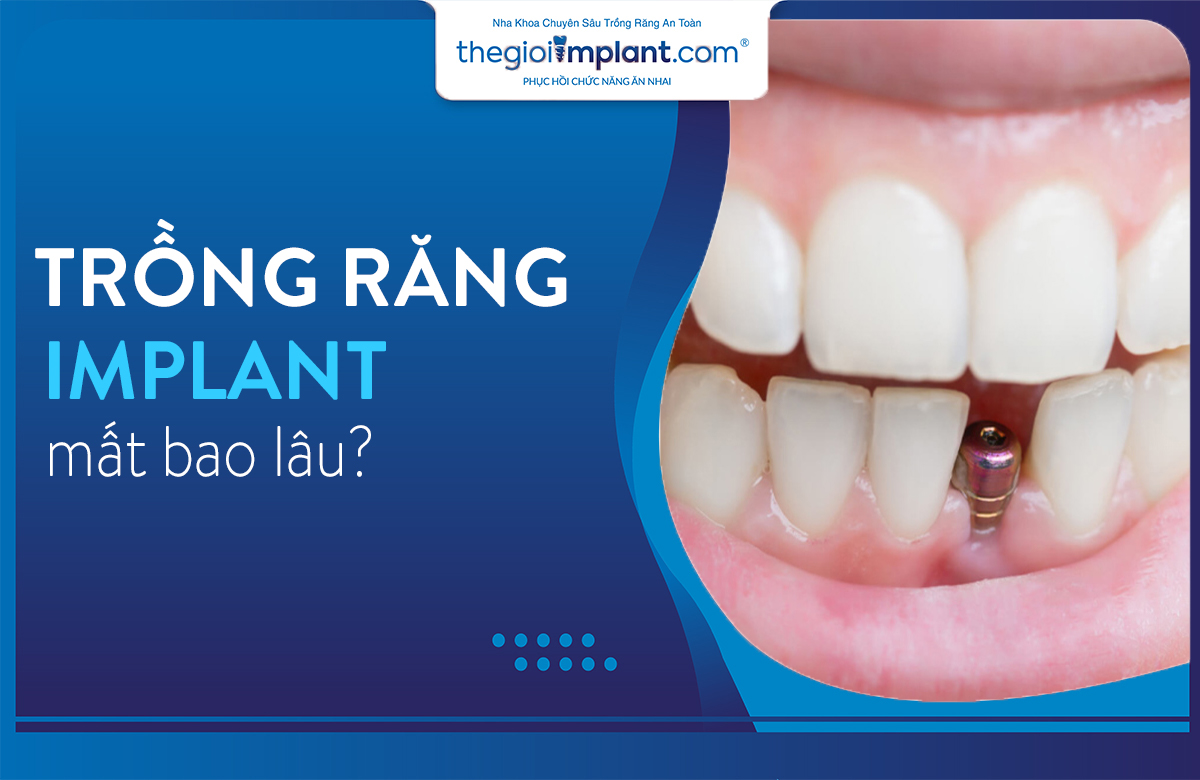 trồng răng implant mất bao lâu thumbnail