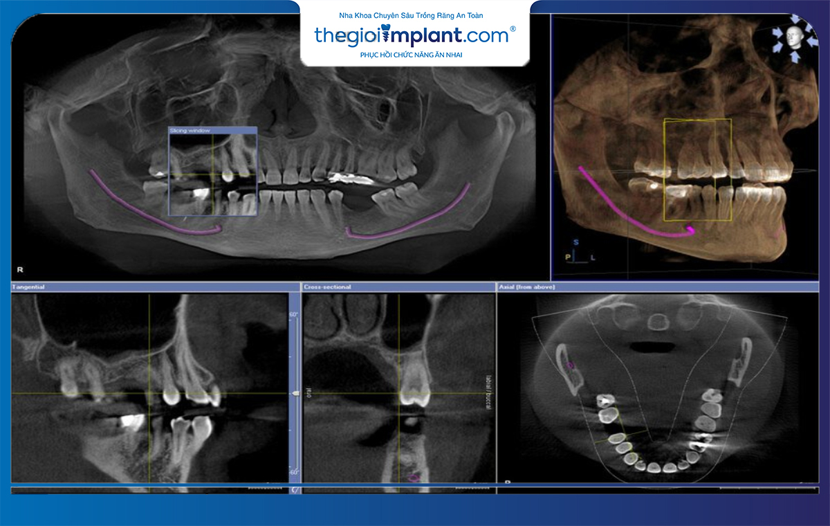 Chụp phim X-quang CT Cone Beam 3D